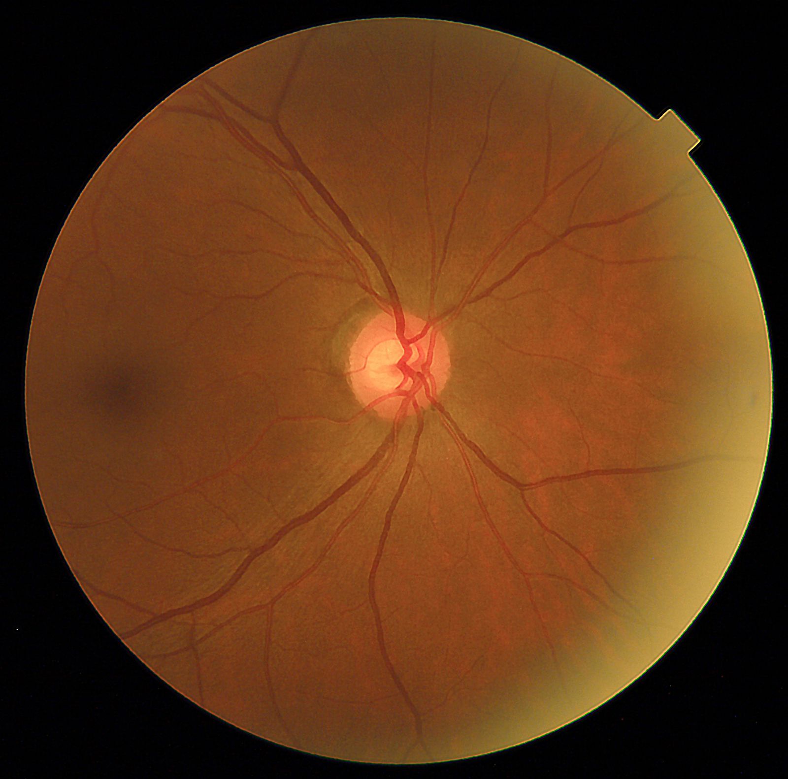 My DR Detection 